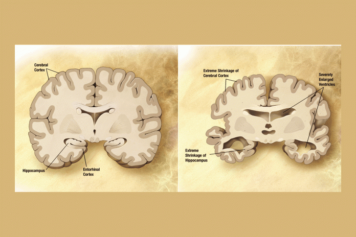 luta contra o Alzheimer