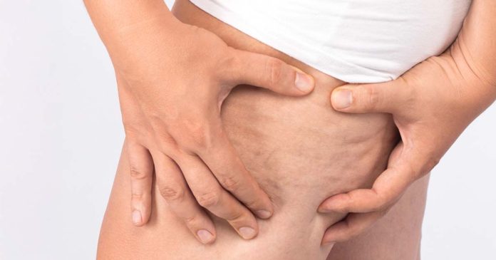 Celulite nos Homens Celulite nos Homens